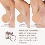 Appareil d'épilation à lumière pulsée Philips BRI949/00 – Image 9